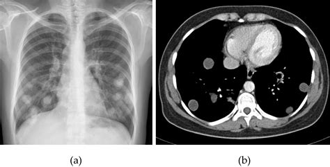 Radiological Characteristics of Pulmonary Hydatid Cysts | IntechOpen