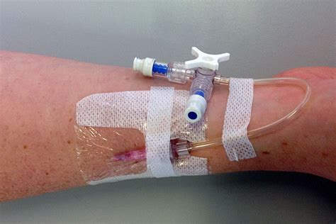 How to Assess a Peripheral Intravenous (IV) Cannula | Ausmed