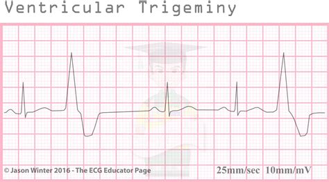 ECG Educator Blog : Ventricular Ectopics