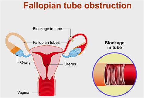 Natural Treatment for Blocked Fallopian Tubes