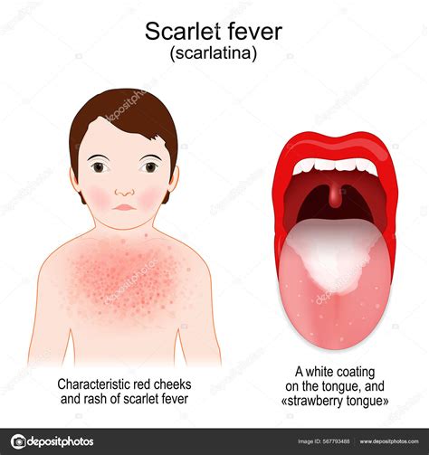 Scarlet Fever Signs Symptoms Scarlatina Child Rash Characteristic Red ...