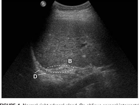 Figure 1 from Sonography of the adrenal glands in the adult. | Semantic ...