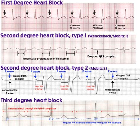 1st Degree Second Degree 1st Degree First Degree Heart Block Ecg - Photos Idea