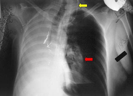 Pneumonectomy: Pneumonectomy Complications