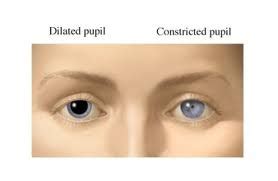 Dilated Pupils - Definition, Symptoms, Causes, Diagnosis and Treatment