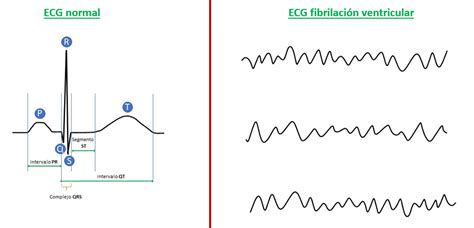 ECG de la fibrilación ventricular: Explicación sencilla