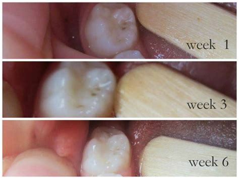 More Photographic Proof Cavities Heal | The Healthy Home Economist