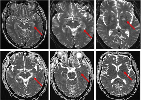 Clinical pathophysiology of hypoxic ischemic brain injury after cardiac arrest: a “two-hit ...