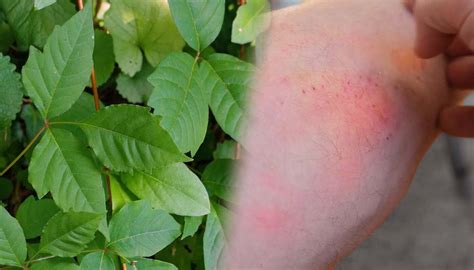 Prevention and Treatment of Rhus Dermatitis and Other Weed Allergies