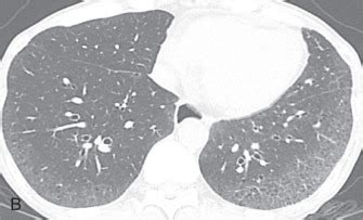 Cystic Lung Disease | Radiology Key