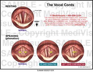 Medivisuals The Vocal Cords Medical Illustration