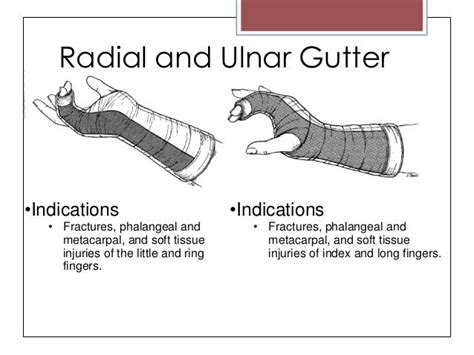 ortho-splinting-traction; gutter splint | Soft tissue injury, Hand therapy, Ortho