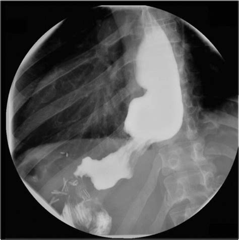 Upper GI series showing hold-up of contrast at the gastrojejunostomy... | Download Scientific ...