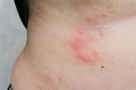 PUPPP Skin Rash During Pregnancy: Symptoms & Causes