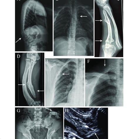 | Special exostosis lesions and complications in some affected MO... | Download Scientific Diagram