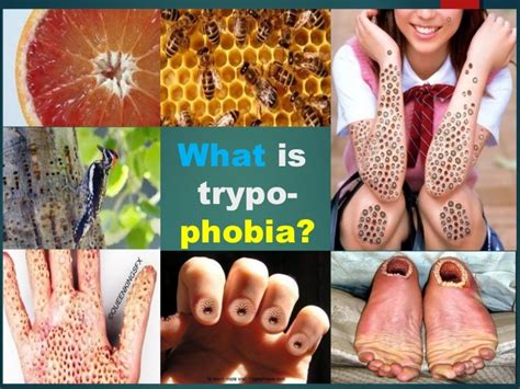 Trypophobia