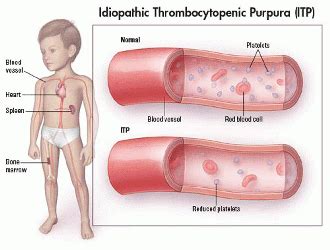 Purpura - Physiopedia