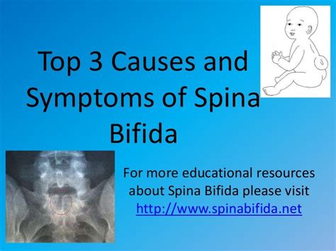 Top 3 causes and symptoms of spina bifida