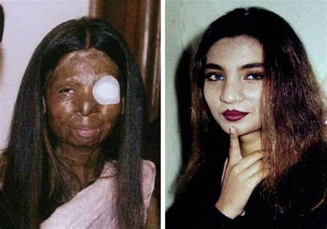 Pakistani acid victim kills herself