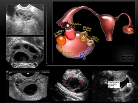 Basic gynae ultrasound