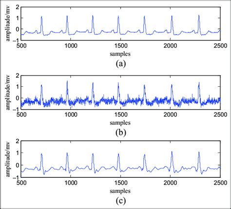 Denoising results of proposed method: (a) original ECG signal; (b) ECG ...