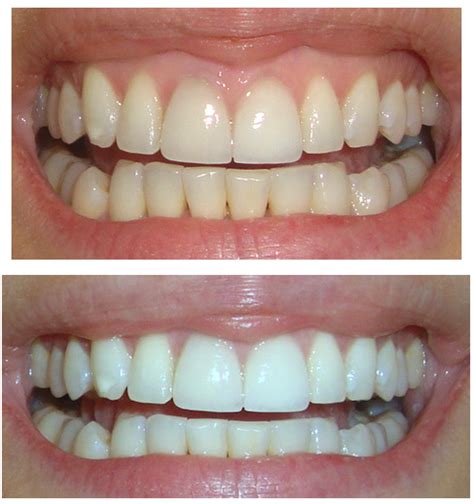 Crest White Strips Before And After - All You Need Infos