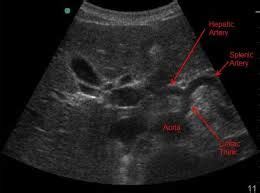 Imagini pentru Gastroesophageal junction of sagittal scan ultrasound | Diagnostic medical ...