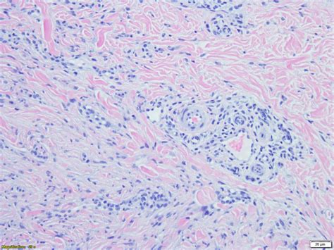 Dermatofibroma Histology