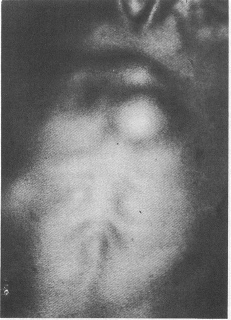 Case 2: Cold abscesses overlying the manubrium and body ofthe sternum. | Download Scientific Diagram