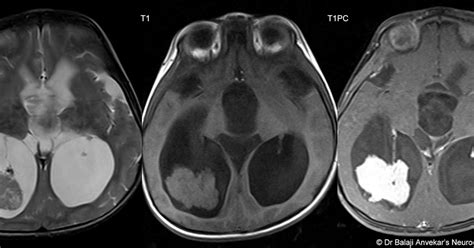 Dr Balaji Anvekar FRCR: Choroid Plexus Papilloma MRI