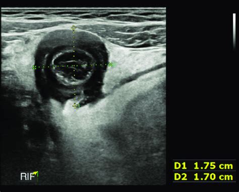 An ultrasound (US) view of the appendix, demonstrating significant... | Download Scientific Diagram