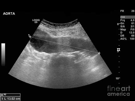 Abdominal Aortic Aneurysm, Ultrasound #1 Photograph by Science Photo ...