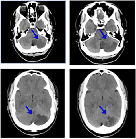 Posterior Inferior Cerebellar Infarct in a Younger Adult Male with ...