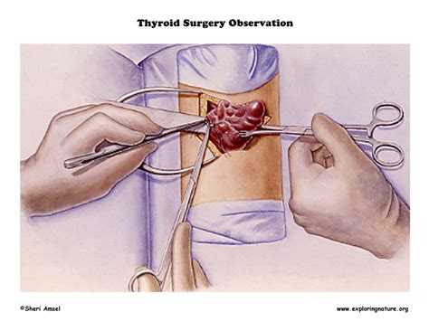 Thyroid Surgery