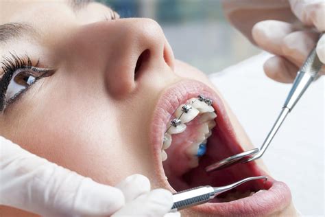 Should I Visit My Dentist While I Wear Braces? - Orthodontic Associates