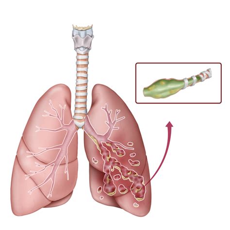 Bronchiectasis: All You Need To Know About It - Medical Channel Asia