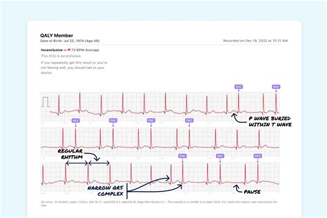 Atrial Bigeminy Vs. Atrial Trigeminy on Your Watch ECG | Qaly