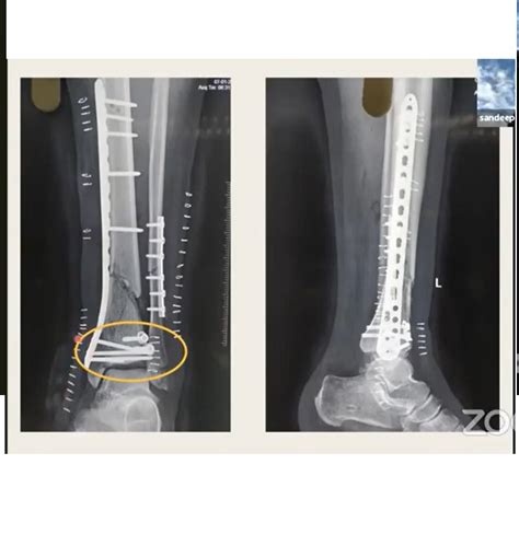 Pilon fracture Case Studies — OrthopaedicPrinciples.com