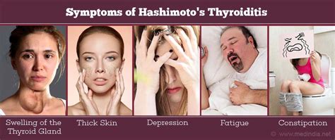 Hashimoto’s Thyroiditis - Risk Factors, Types, Causes, Symptoms, Diagnosis, Treatment ...