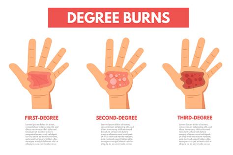 Degree Burns Of Skin Infographic Vector Illustration Stock Illustration - Download Image Now ...