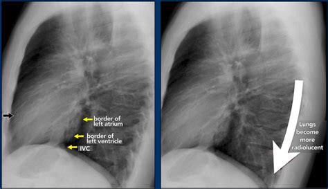 Normal Lateral Chest Xray