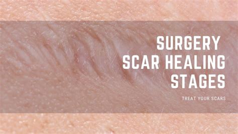 Surgery Scar Healing Stages - Treat Your Scars