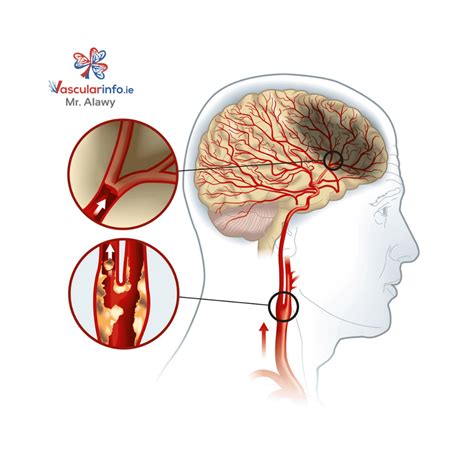 Carotid Endarterectomy - Vascular Info