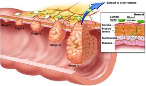 Colon Polyps: Learn The Facts Here - Step To Health