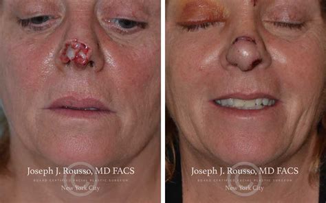 Before and After Reconstructive Surgery Results | New York, NY