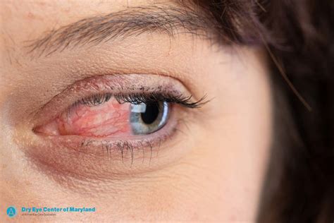 The Best Ocular Rosacea Treatment | Dry Eye Center