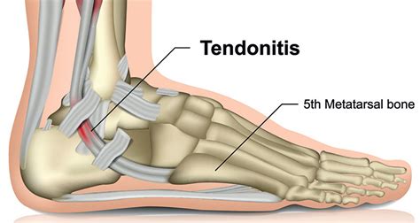 Peroneal Tendonitis (Tendinopathy) - Symptoms, Causes & Treatment