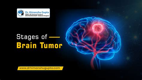 4 Stages of Brain Tumor - Dr. Himanshu Gupta