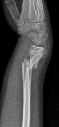 Colles fracture - dinner fork deformity | Image | Radiopaedia.org