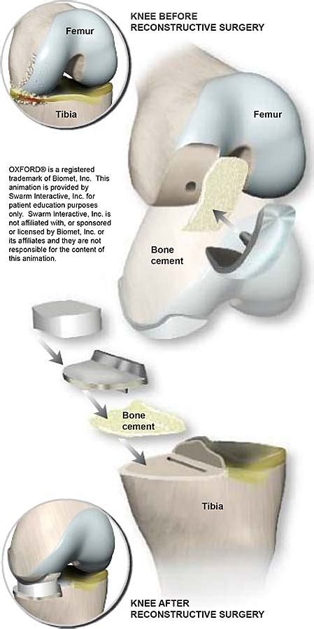 Partial Knee Replacement (using OXFORD® implant) | Central Coast Orthopedic Medical Group